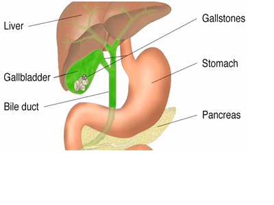Gallstones | The Happy Surgeon
